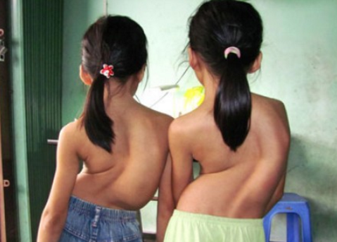 Cách điều trị đau cột sống bằng ghế massage tại nhà